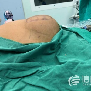 勿以“疝”小而不為 專家建議：及早干預(yù)才是明智之選